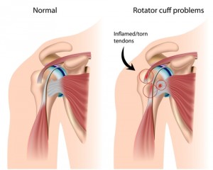 rotator cuff injury cases