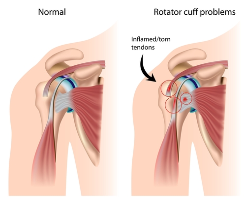 How To Win A Carpal Tunnel Workers' Comp Claim Marina del Rey thumbnail