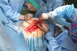cardiothoracic surgeon malpractice