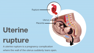 uterine rupture malpractice