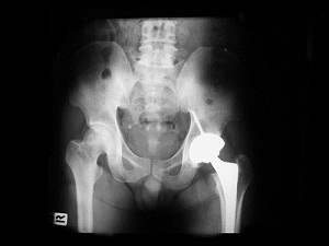 stryker hip replacement settlement