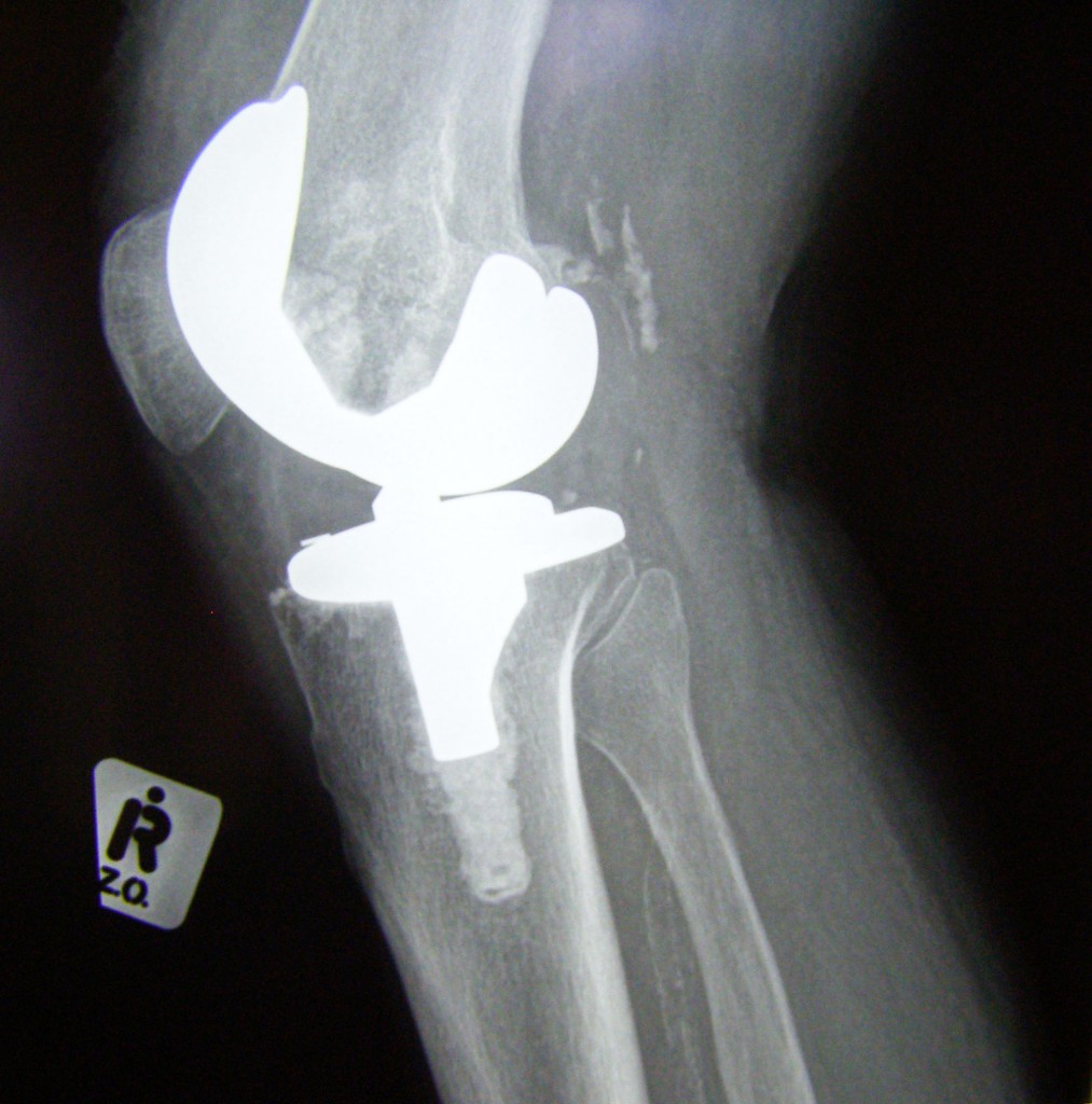 Knee Replacement Category Archives — Lawsuit Information Center