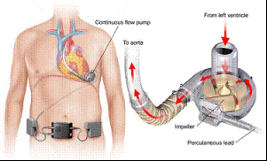 heartware vas recall