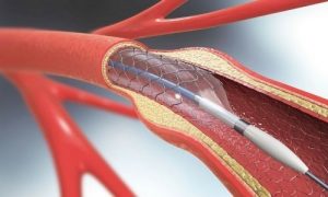 Venous Stent