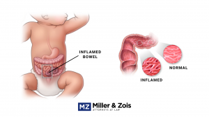 inflamed-bowel-300x169