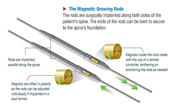 Magnetic-Growing-Rods