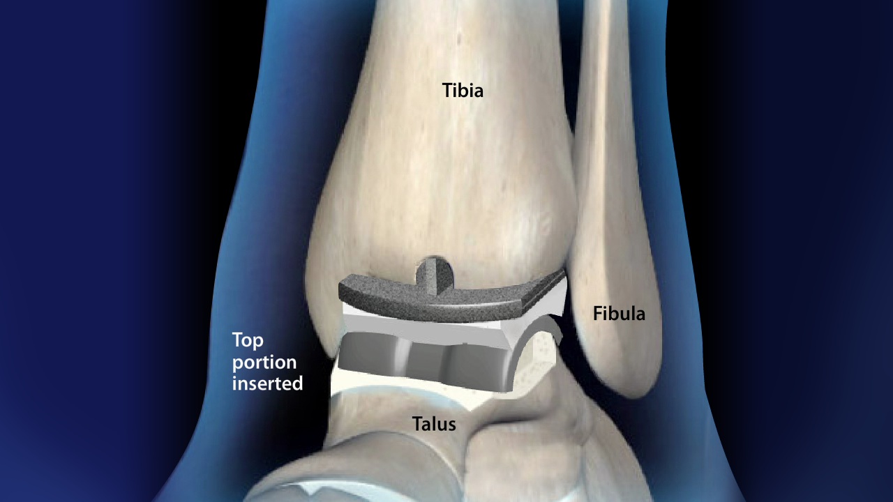 ankle replacement recall lawsuit