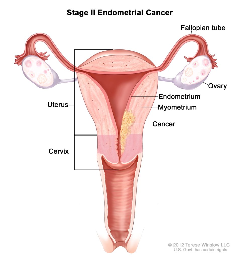 hair relaxer endometrial cancer lawsuit