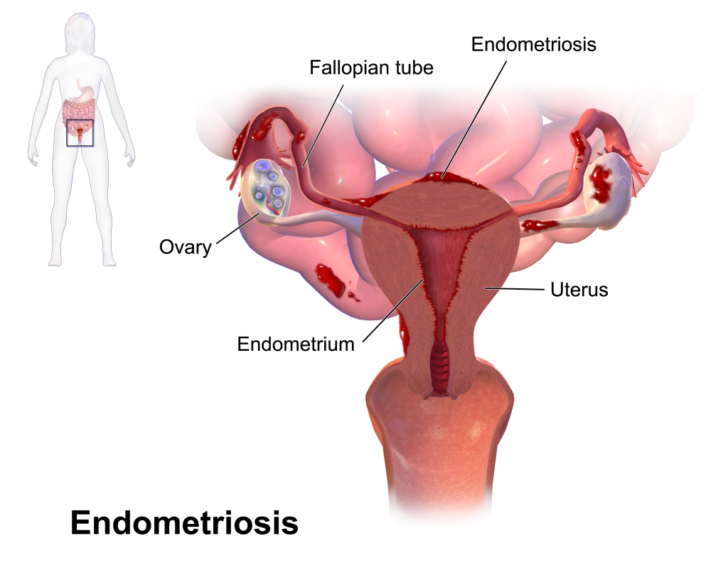 UNC Center for Endometriosis