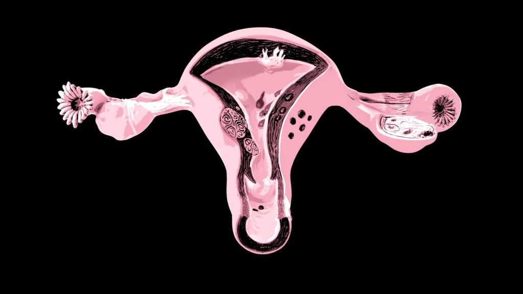 hair restorer ovarian cancer